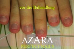 Nagelbeißer vor der Behandlung