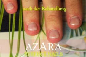 Nagelbeißer nach der Behandlung